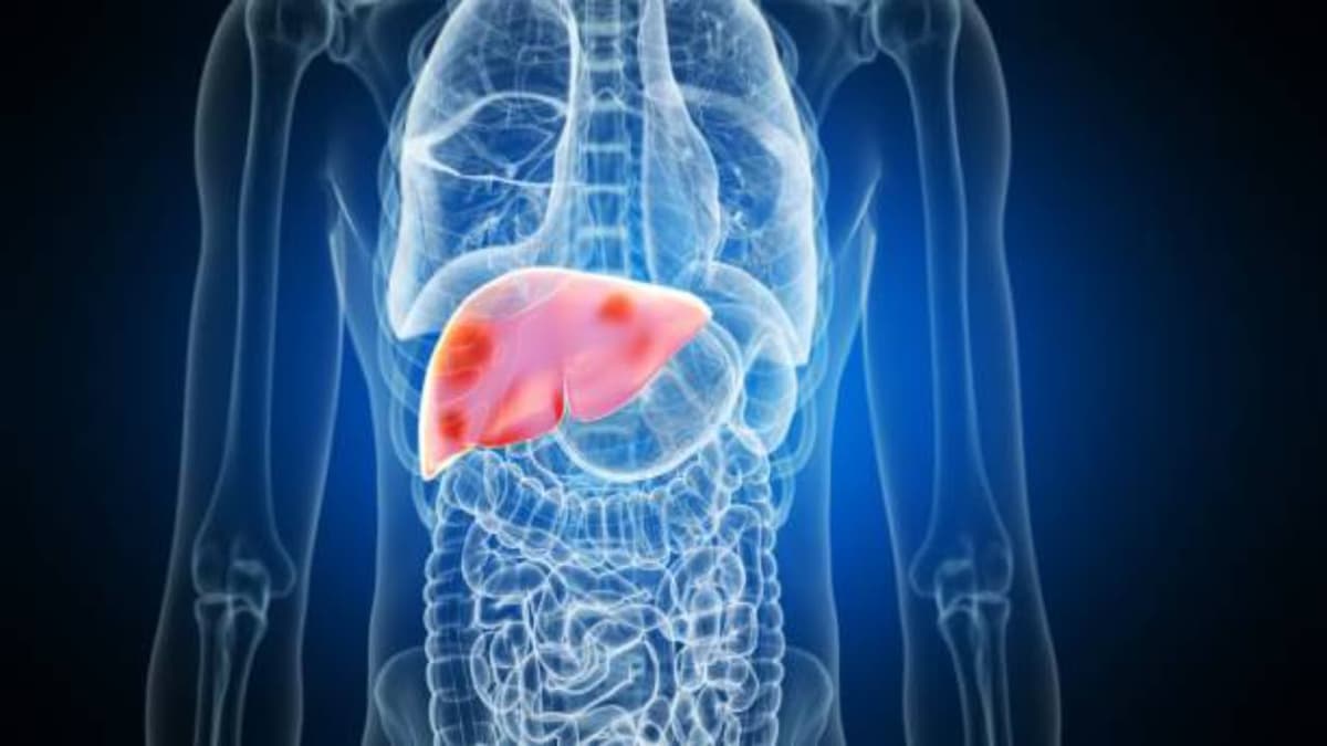 Five Tips to Combat Fatty Liver:ഫാറ്റി ലിവറിനെ ചെറുക്കാൻ ശ്രദ്ധിക്കേണ്ട അഞ്ച് കാര്യങ്ങൾ