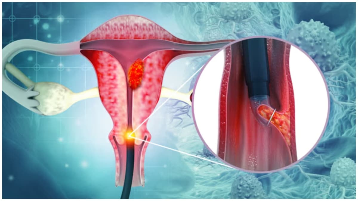 Cervical Cancer Symptoms: സെർവിക്കൽ ക്യാൻസർ ; ഈ അഞ്ച് ലക്ഷണങ്ങൾ അവഗണിക്കരുത്